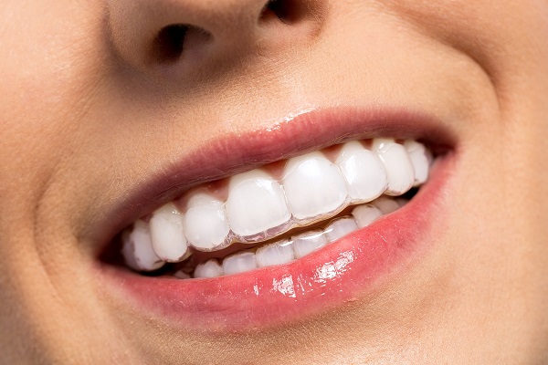 Invisible Braces for Adults Ottawa